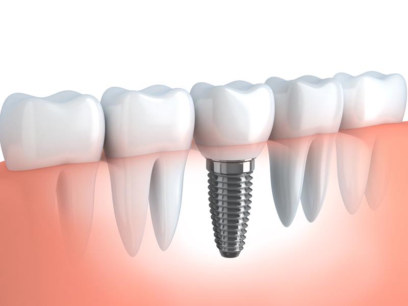 Dental Implants Lomita, CA