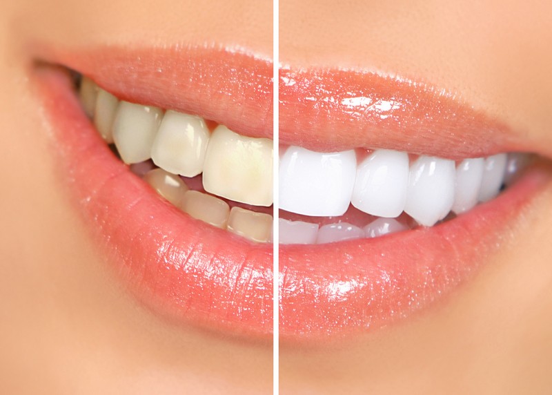 Teeth Whitening  Lomita, CA 